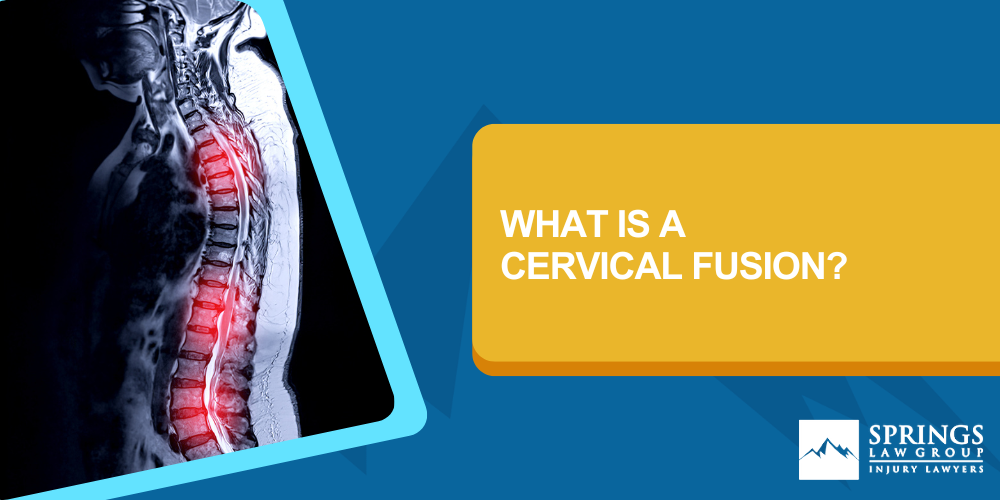 I Need A Cervical Fusion After A Colorado Springs Auto Accident; Rights After A Cervical Fusion Caused By A Colorado Springs Auto Accident; What Is A Cervical Fusion