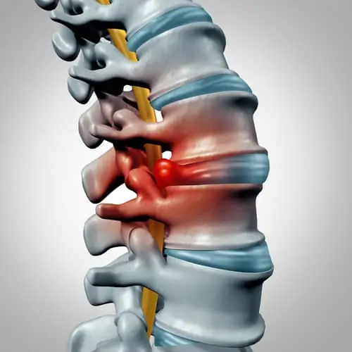 Abogado especializado en hernia discal de Colorado