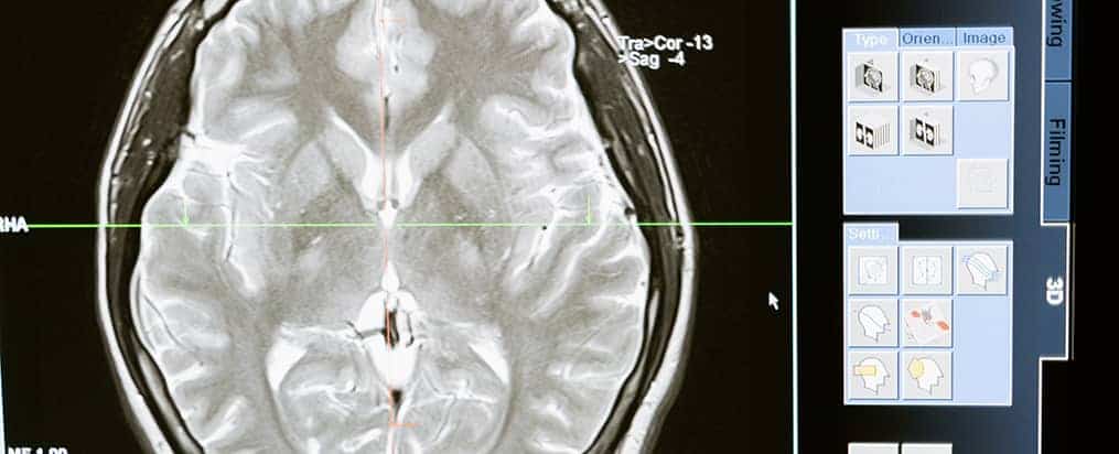 Colorado Springs Traumatic Brain Injury Lawyer
